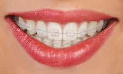 traditional braces by longmont braces in Longmont, Colorado. Located in Boulder County near Hygiene, Niwot