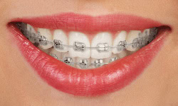traditional metal brackets attached to teeth