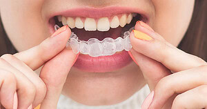 Clear Aligners for Adults