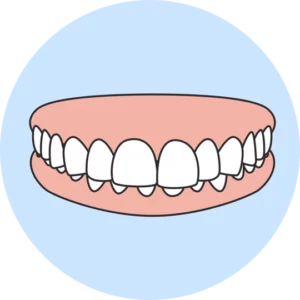 Diagram of moderate overbite malocclusion