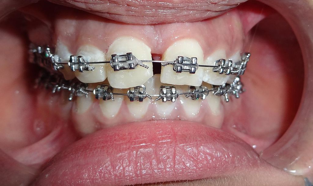 Medically Necessary Braces - Severe Malocclusion - Longmont Braces