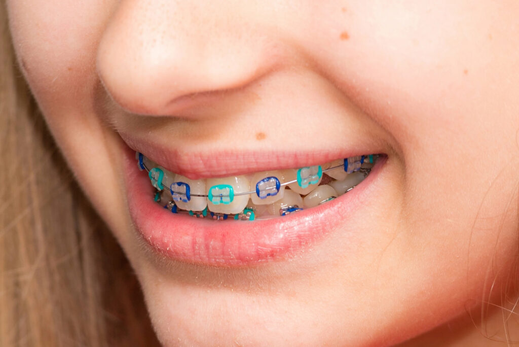 What are the best braces colors - Longmont Braces - Braces Color Wheel Braces Color Palette