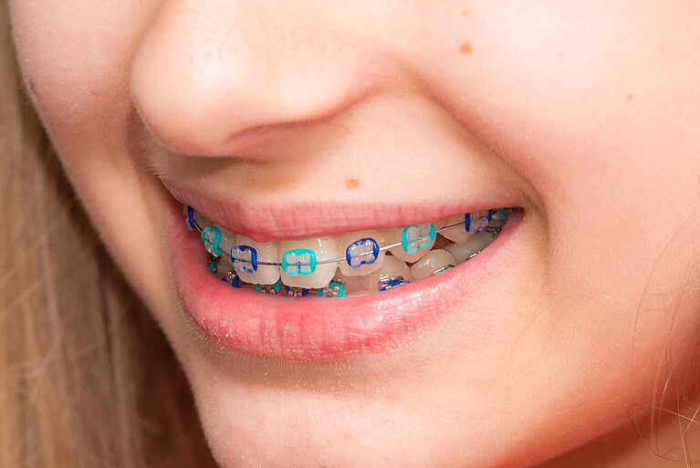 What are the best braces colors - Longmont Braces - Braces Color Wheel Braces Color Palette